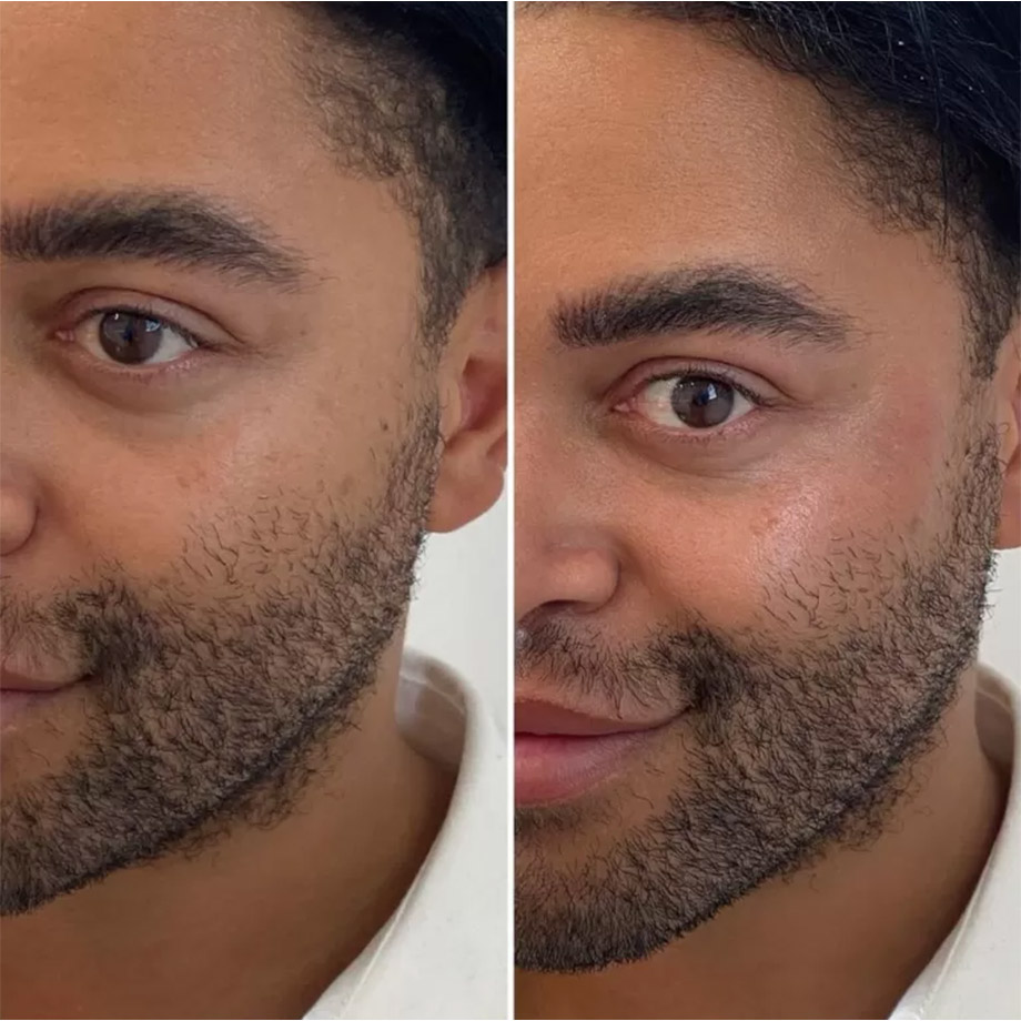 Cheek Filler Tracie Giles London