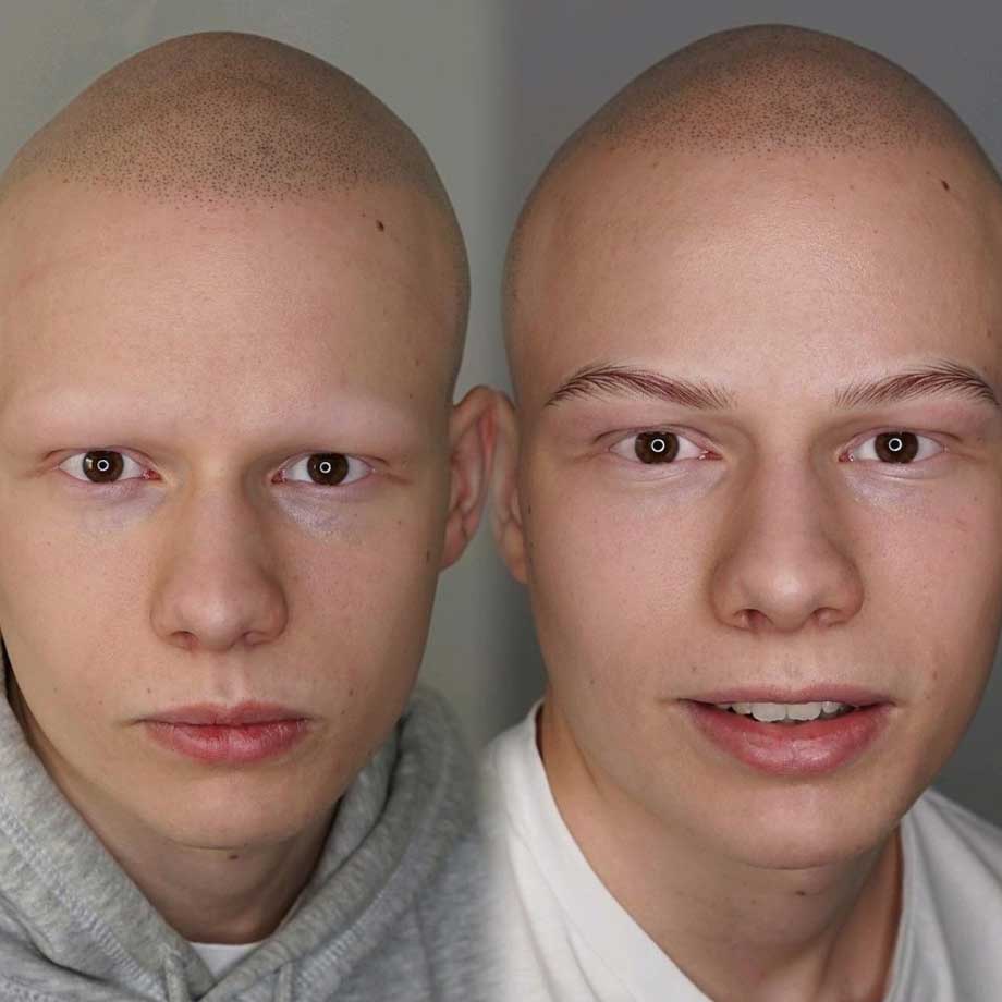 Eyebrow Tattooing for Hairloss