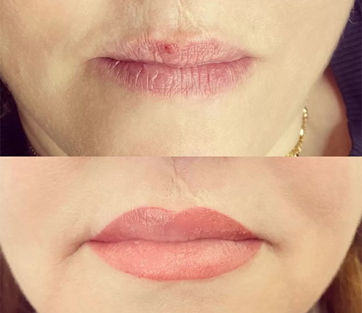 Cleft Lip Scar Camouflage