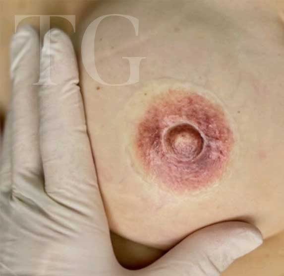 Female breast with Areola Tattoo