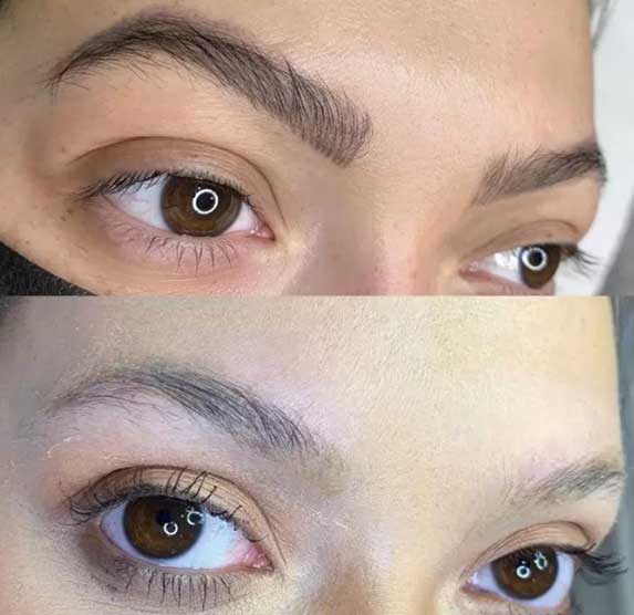 Permanent Makeup Removal