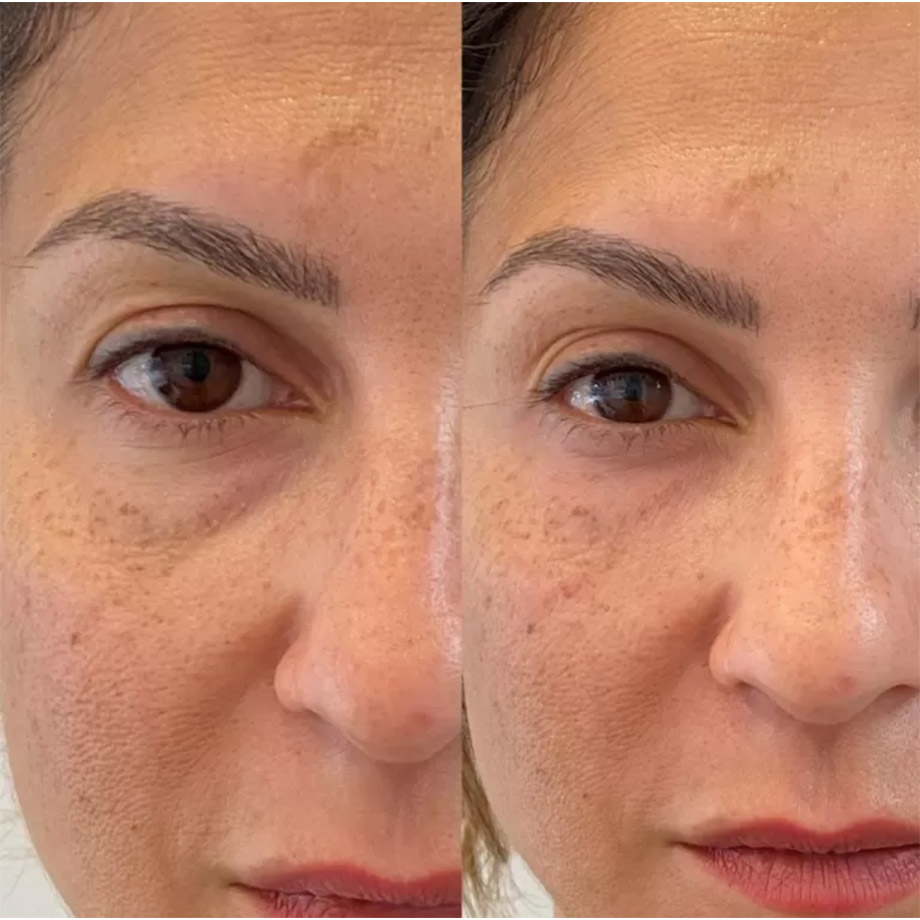 Tear Trough Filler