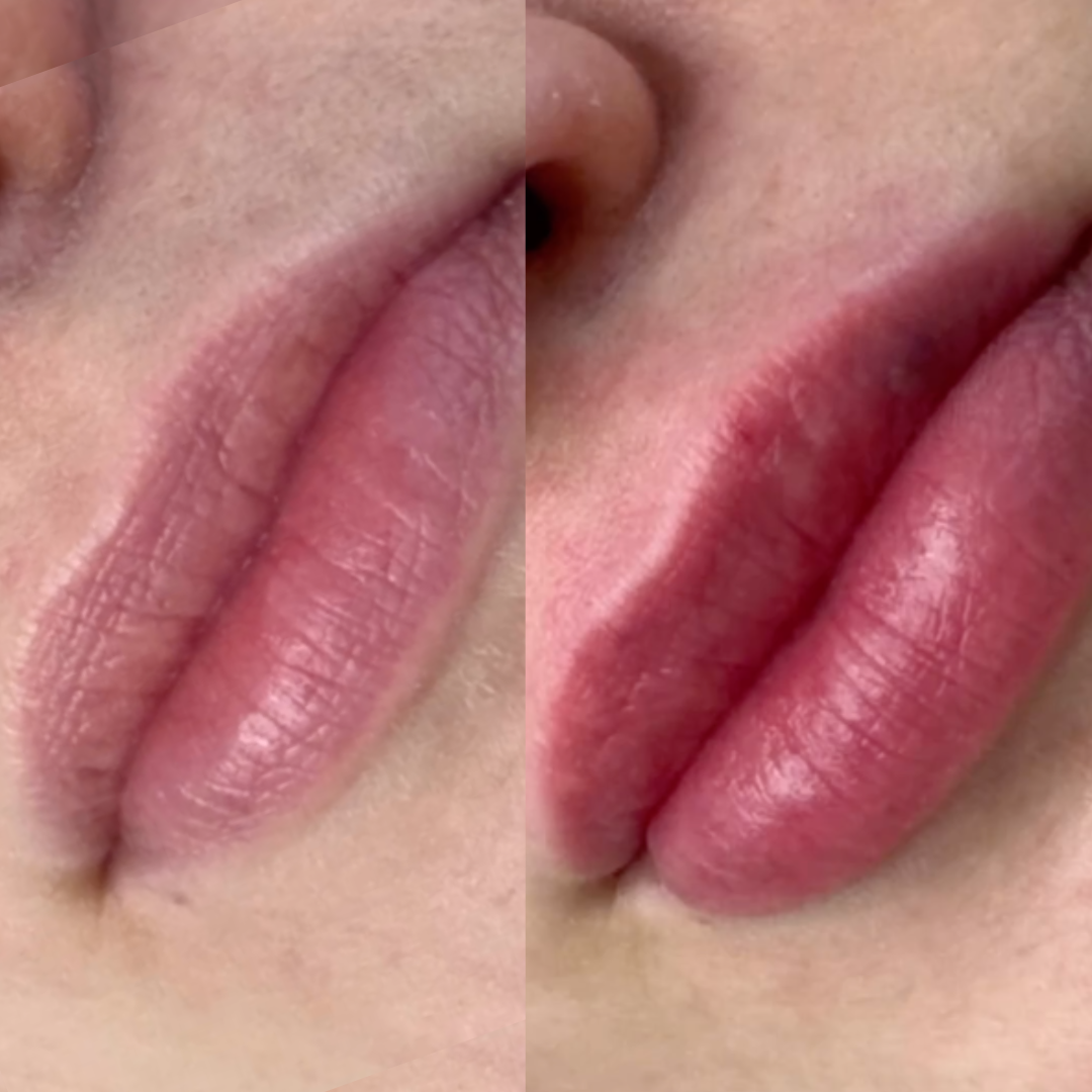 Skinfill Bacio Results